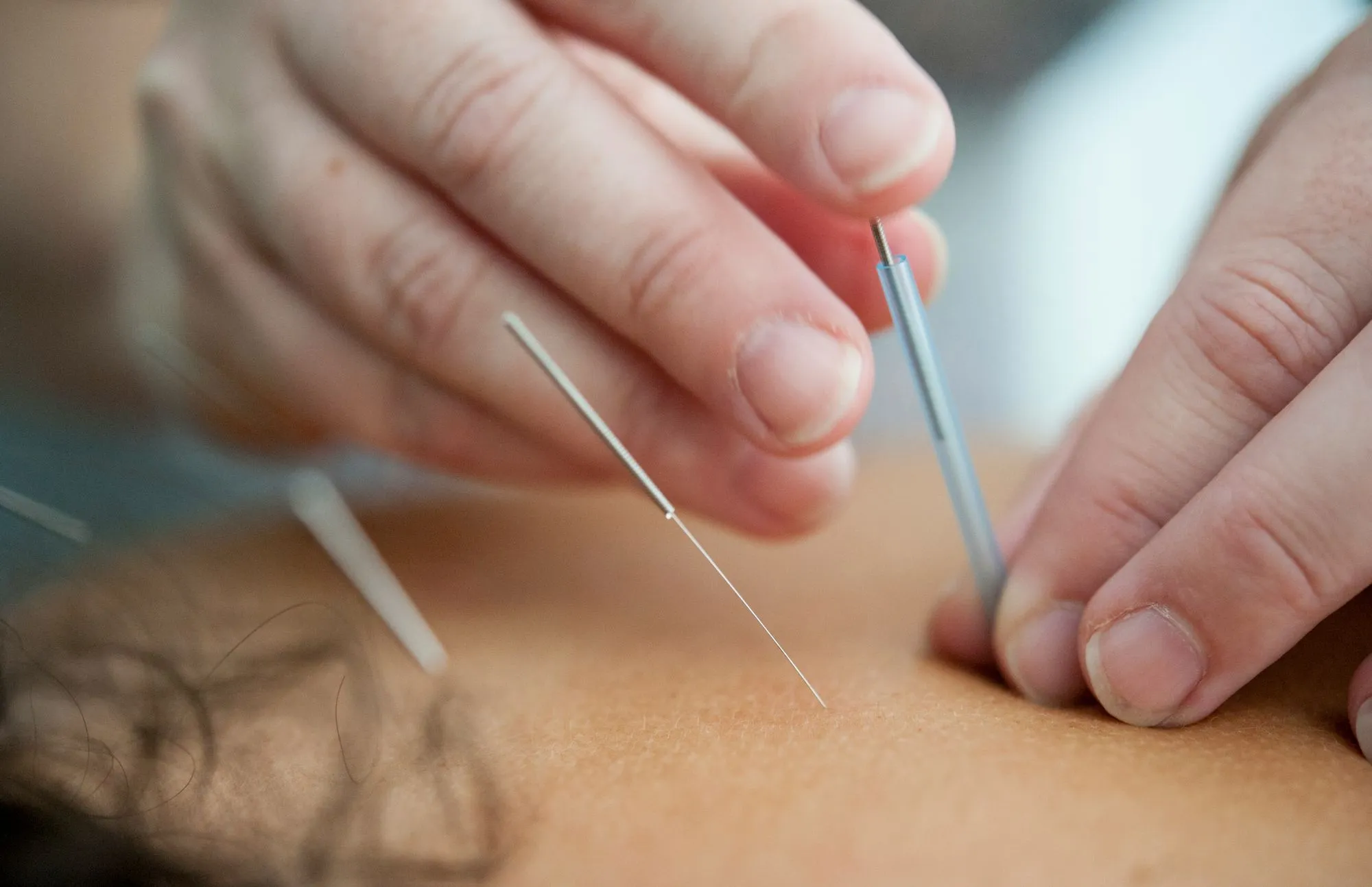Acupuncture While Pregnant